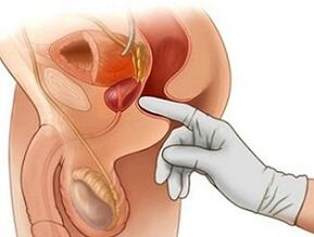 前列腺按摩治疗男性前列腺炎