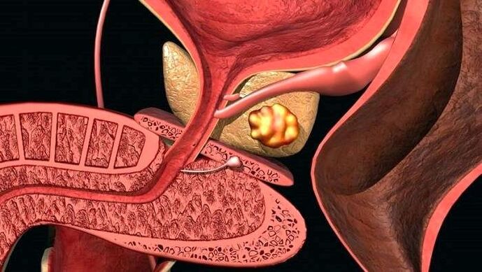 前列腺结石沉积并伴有结石性前列腺炎