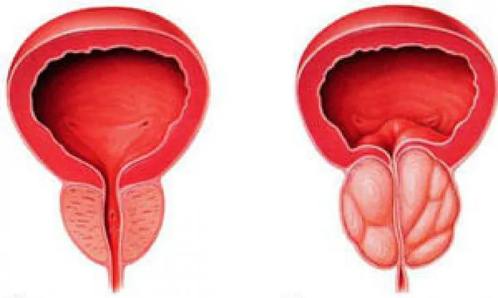 正常前列腺（左）和发炎的慢性前列腺炎（右）